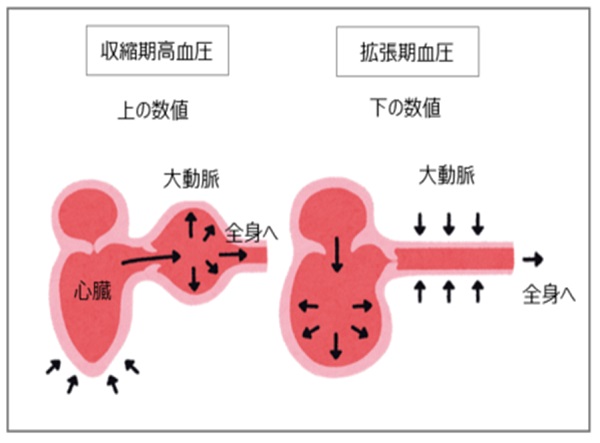 収縮期高血圧「上の数値」, 拡張期血圧「下の数値」, 仕組み参考図